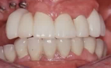 Treatment of the edentulous maxilla with immediate function (SPANISH LANGUAGE O