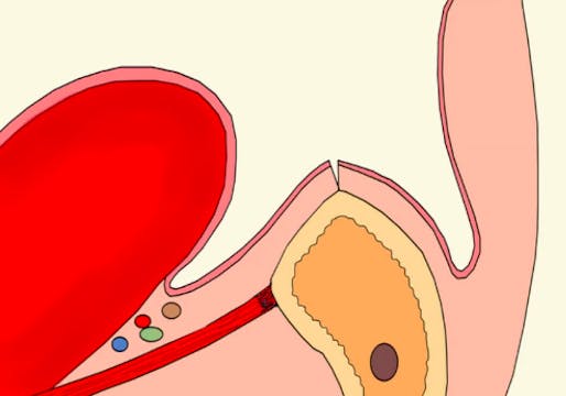 CLINICAL VIDEO How to Release the Lin...