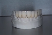 Newest Dental Laboratory Techniques in Implant Esthetics