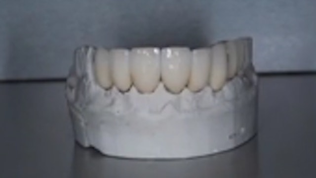 Newest Dental Laboratory Techniques in Implant Esthetics