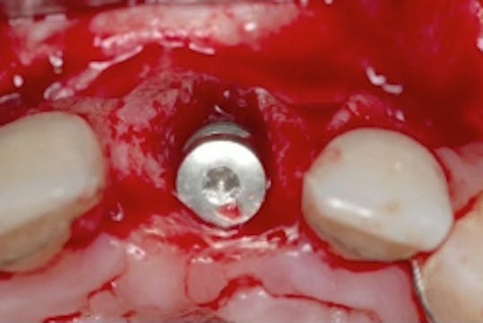 Dental Biochemistry – Role of Biofilm...