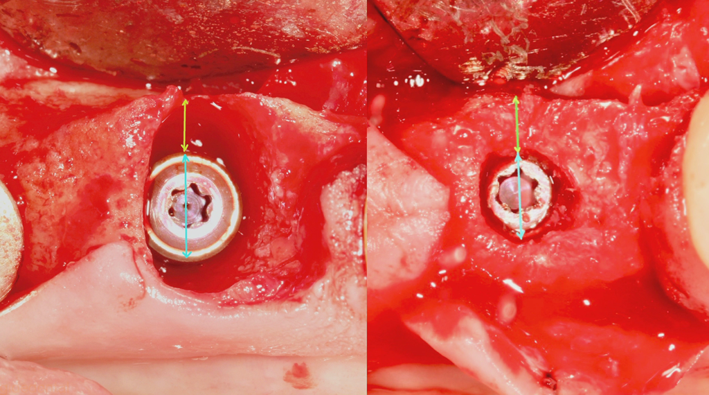 Socket Preservation using a Novel Membrane Technique