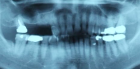 CLINICAL VIDEO Sinus and Socket Bone Augmentation with Simultaneous Placement of