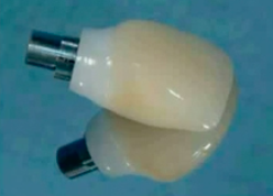 Anterior Esthetic Implant Treatment | Dr Bernard Touati