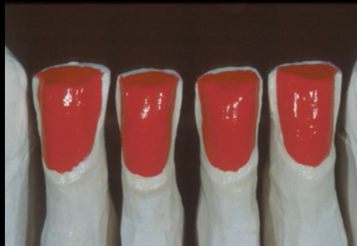 Indirect Anterior Restorations: Veneers and Crowns