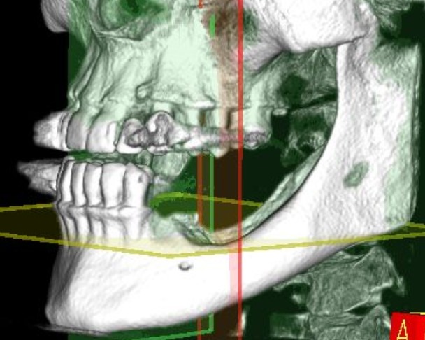 CLINICAL VIDEO Vertical Ridge Augmentation in the posterior mandible using GBR 