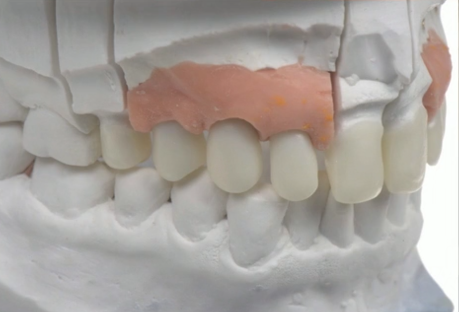 How to Create High End and Esthetic Results in Implantology using the Digital W