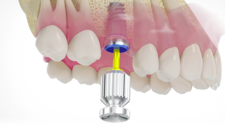 Optimize the Biology and Tissue Behavior for an Esthetic and Stable Implant Res