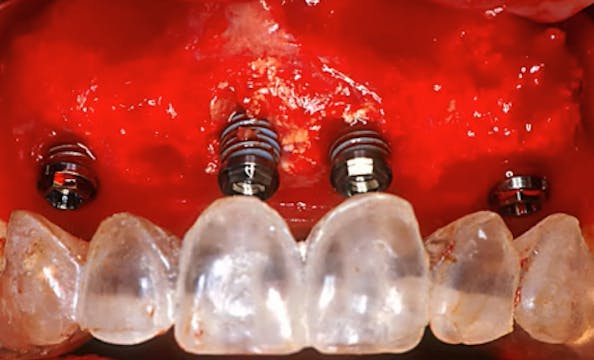 Vertical ridge augmentation using alv...