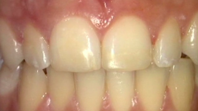 CLINICAL VIDEO  Treatment of class IV restorations using the natural layering te