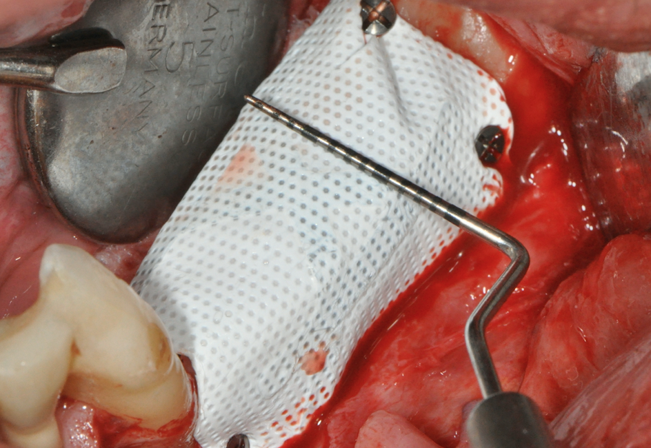 [PLAYLIST] GBR 4 Part Series by Dr Marco Ronda