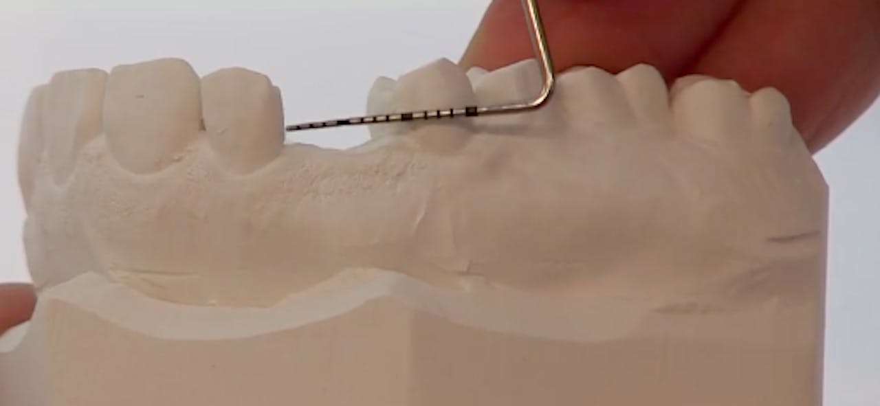CLINICAL VIDEO Anterior Implant Placement with Immediate Temporization