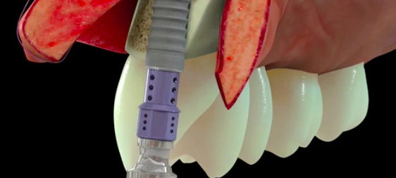 Implant Placement PostExtraction with Simultaneous Contour Augmentation|Dr Buser
