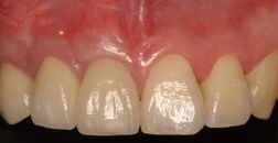 Predictable Soft Tissue Grafting for Esthetics in Thin Periodontium |Dr Paul Lin