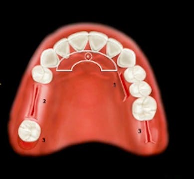 Soft Tissue Grafting for Implant Comp...