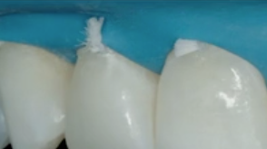 Conservative Rehabilitation of Abrasion & Erosion Cases