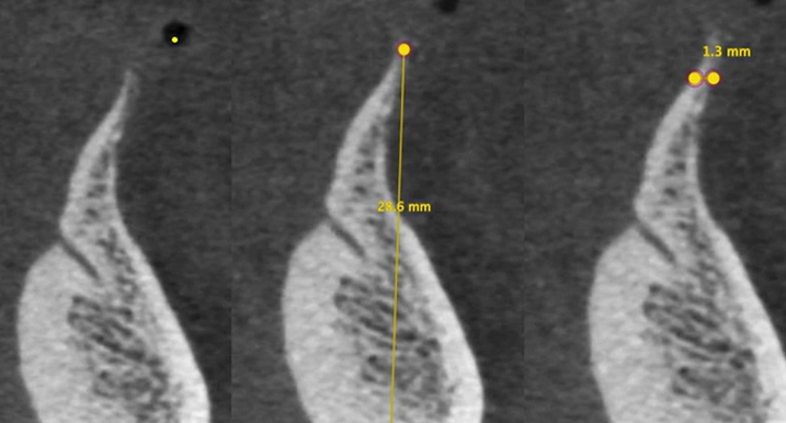 CLINICAL VIDEO Staged Horizontal Ridge Augmentation using GBR  | Dr  Jovanovic