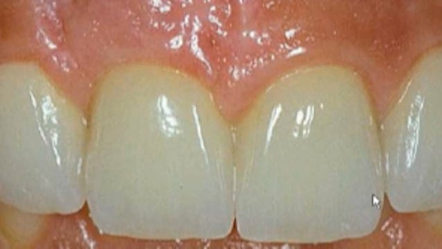 Ridge and Sinus Grafting In Implant D...