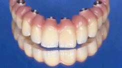 Guided Implant Surgery - A New Dimension in Surgical Precision