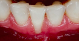 CLINICAL VIDEO Root Coverage - Deep Single Recession