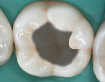 A Simplified Layering Method for Direct Posterior Restoration | Dr N.Takahashi