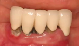 A-Z in Restorative Implant Dentistry (Case 3) - Maxillary Full Arch Overdenture