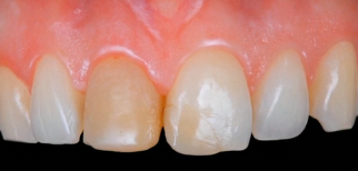 CLINICAL VIDEO Immediate Tooth Replacement with a Preplanned Final Custom Abutme