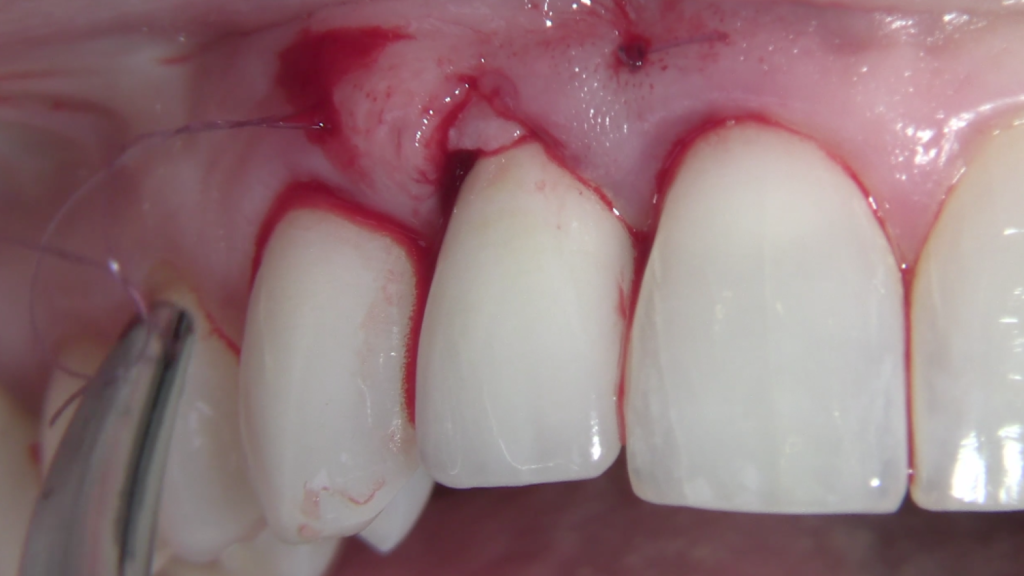 CLINICAL VIDEO Implant Gingival Recession Treated with a Tunneling Procedure and