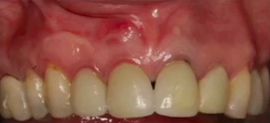 CLINICAL VIDEO Solving a Thin Gingival Biotype in the Upper Anterior with a 