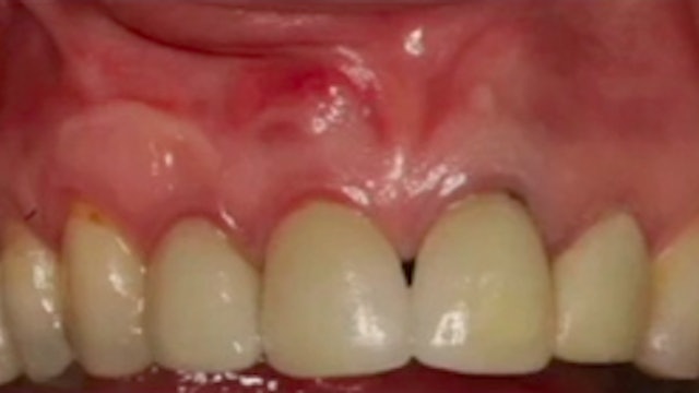CLINICAL VIDEO Solving a Thin Gingival Biotype in the Upper Anterior with a 