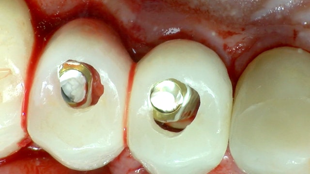 CLINICAL VIDEO Immediate Implant Temporization on 2 Upper Implants