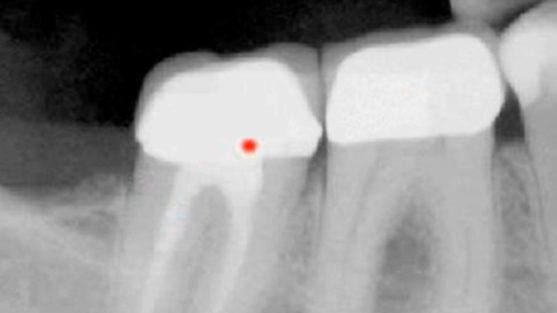 Restoration of Endontically Treated Teeth