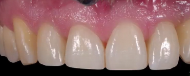 CLINICAL VIDEO Single Tooth Esthetic Implant Replacement - From Diagno