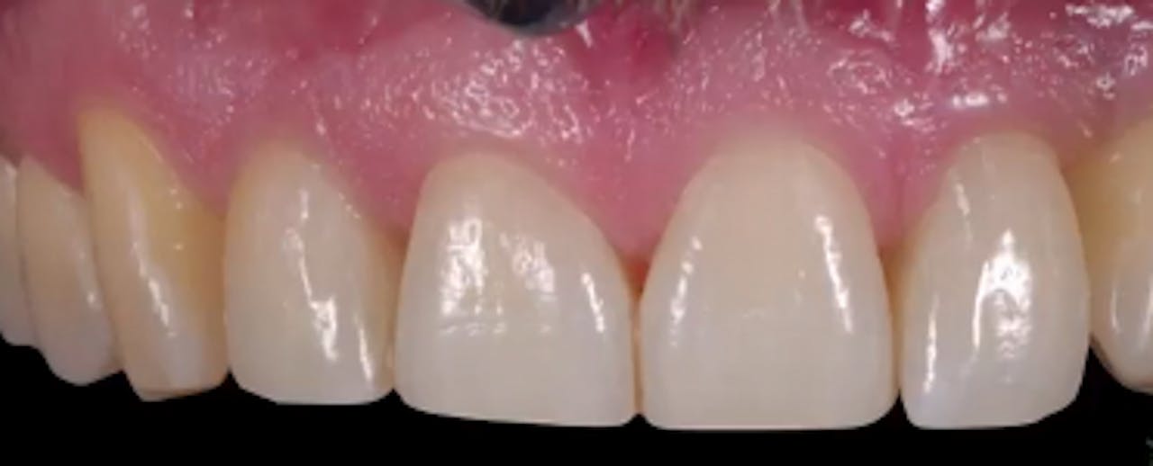 CLINICAL VIDEO Single Tooth Esthetic Implant Replacement From Diagno