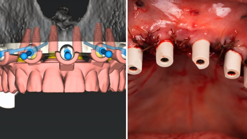 Full-Arch Scanning for All-on-X Rehabilitation