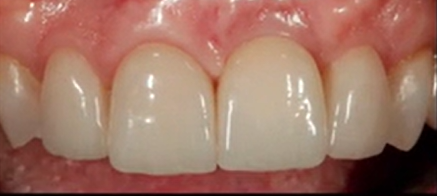 Principles of Guided Bone Regeneration | Dr Istvan Urban