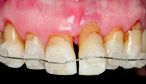 Predictability of the Extraction Site Implant Part 2: Maxillary Anterior Implan