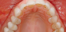 Tooth wear Interceptive & Conservative Treatment | Dr Didier Dietschi