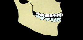 Occlusion and Titanium