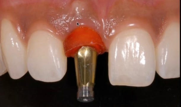 Immediate implant temporization of a ...