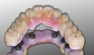 Protesi Fissa Ibrida in Zirconia: Nuovi Materiali e Protocolli (ITALIAN LANGUAG