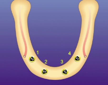 The All on 4 Concept: Diagnosis to De...