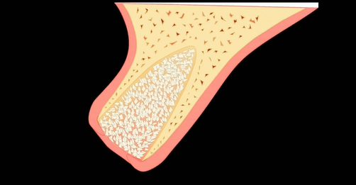 Alveolar Ridge Preservation for Implant and Pontic Site Development | Dr Bartee