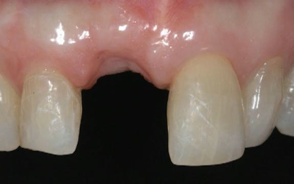 CLINICAL VIDEO Vertical Ridge Augment...