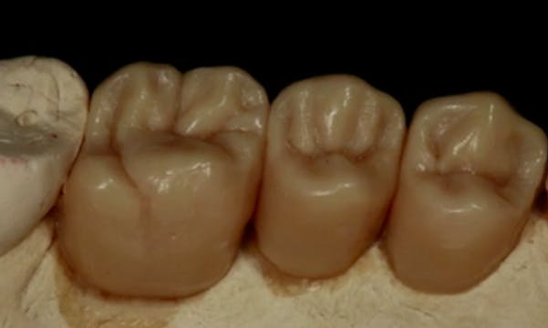 CLINICAL VIDEO Sinus Elevation and GB...