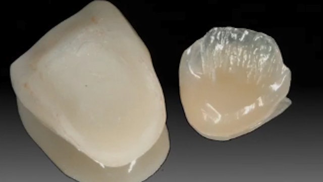 No Post, No Crown: Biomimetic Restorative Dentistry
