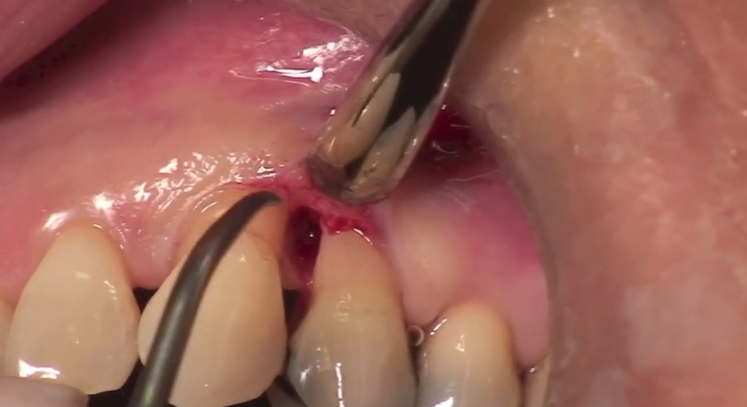 Clinical Concepts in Regenerative Periodontal Therapy | Dr Giulio Rasperini