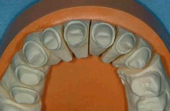 Integration of Digital-Ceramic Restorations