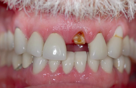 A-Z in Restorative Implant Dentistry (Part 5) - Provisionals: Their Use and Tim