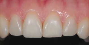 Conservative Rehabilitation of Abrasion & Erosion Cases | Dr Didier Dietschi